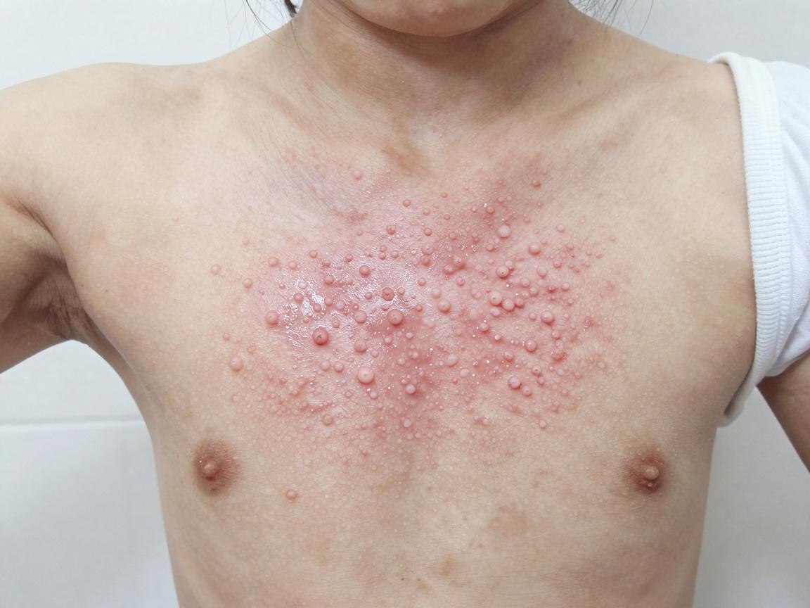 合肥儿童腋臭治疗，专业医院如何选择？儿童腋臭治疗要趁早