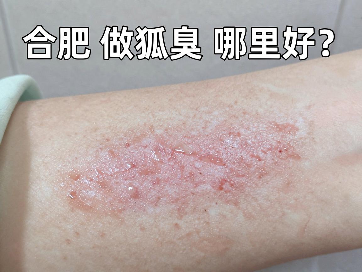 合肥做狐臭哪里好？专业医生告诉你合肥做狐臭的靠谱选择